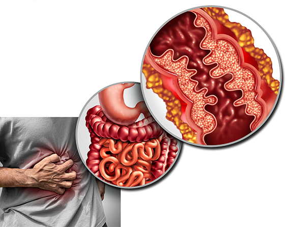 crohn nosos stoma