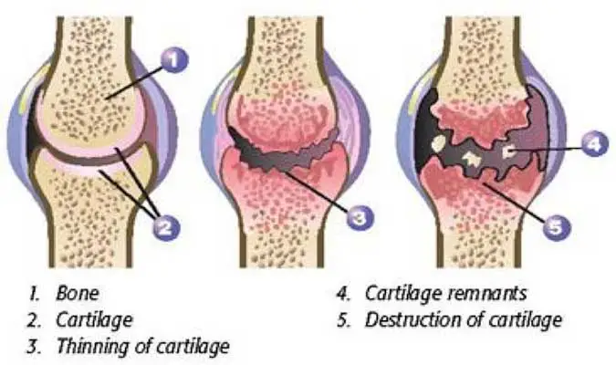 osteoarthritis c