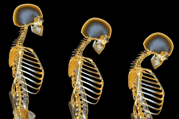 osteoporosi 1