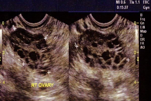 pcos 1