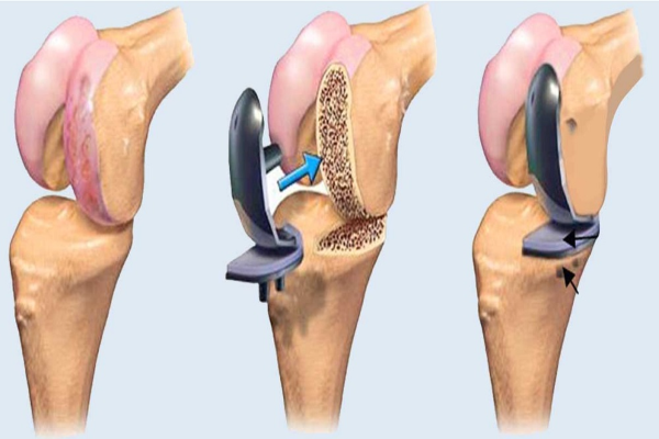 arthrosi 2