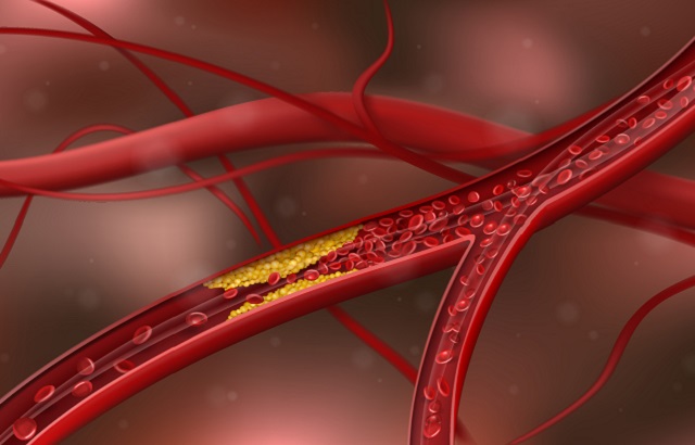 atherosclerosis