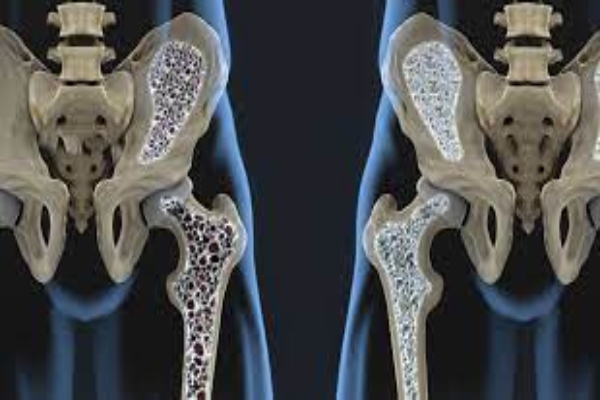 osteoporosi 1