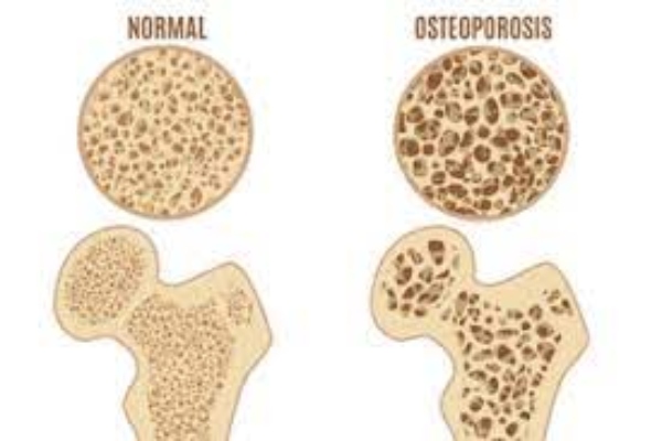 osteoporosi 2