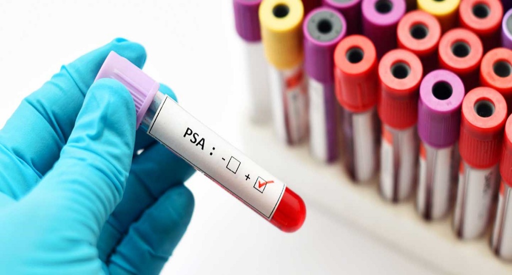 psa prostate test blood vial lg