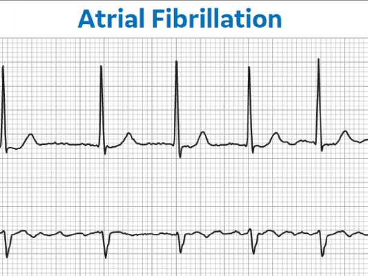 afib e1695146367113