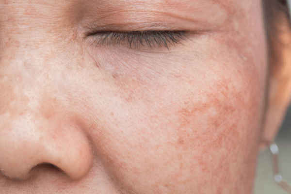 melasma e1695021148486