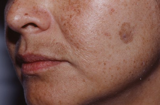 melasma prosopo