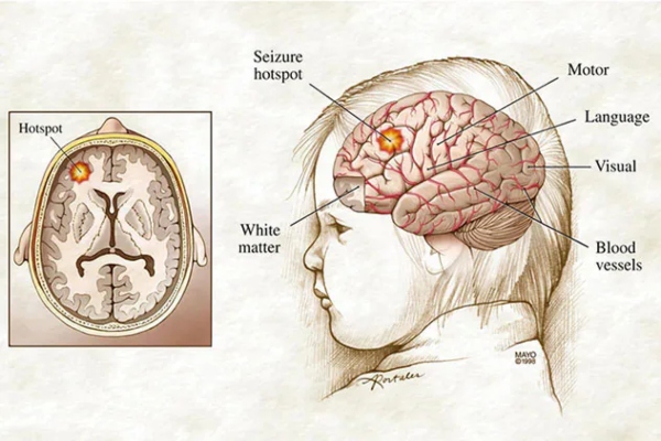 neurologiko 1