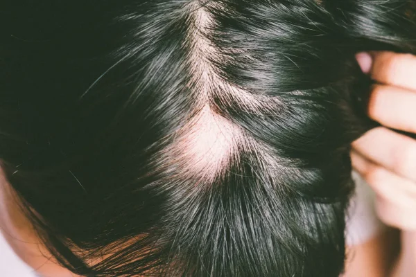 alopecia e1697008608183