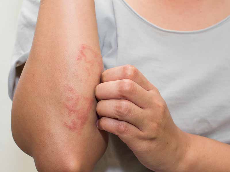 eczema