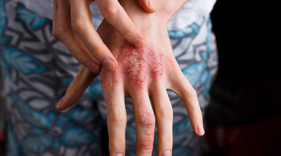 eczema atopic dermatitis