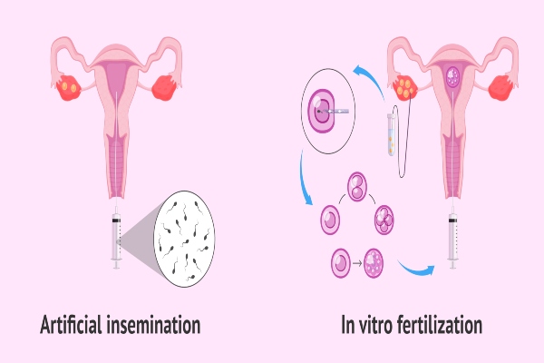 ivf 2