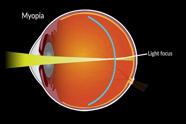 myopia 1