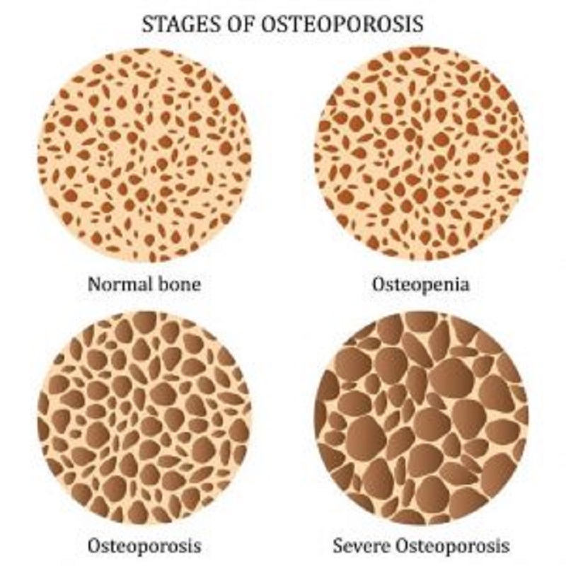 osteoporosi b