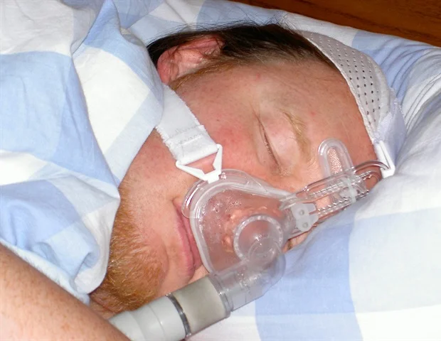 sleep apnea