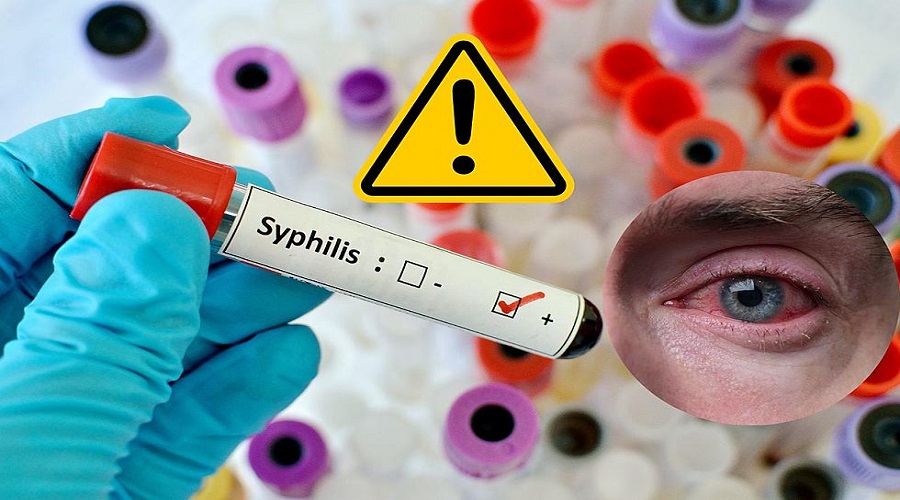 syphilis