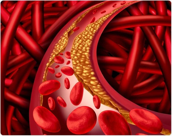 embolism a