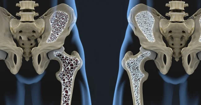 osteoporosis e1701853153217