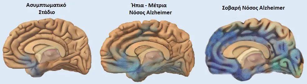 alzheimer b