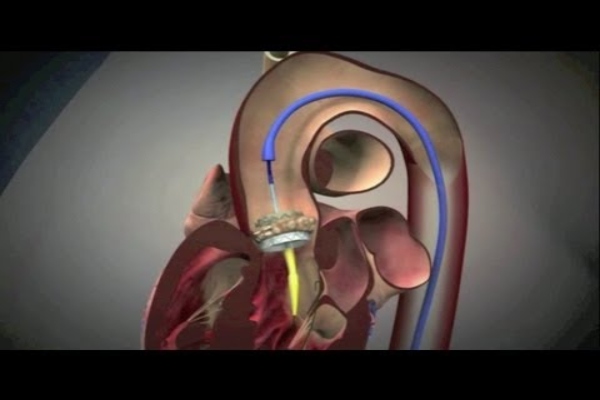 aorti 2