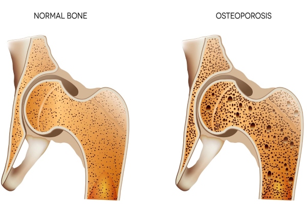 osteoporosi 2 1