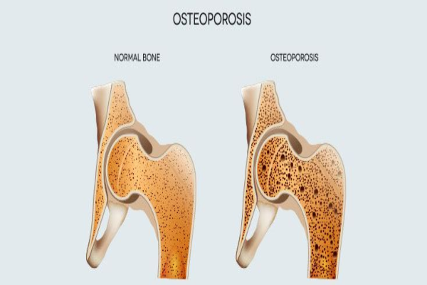 osteoporosis 1