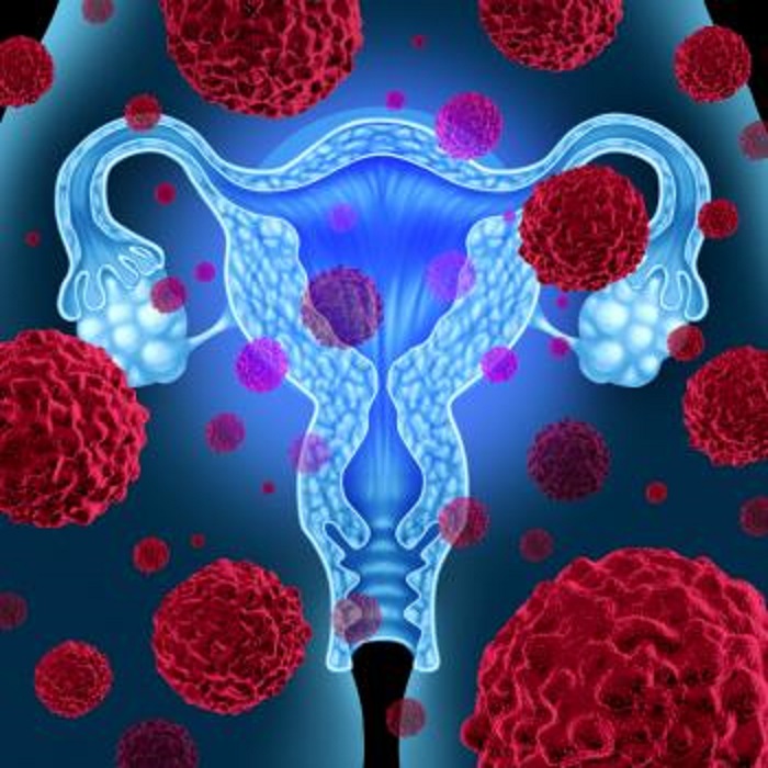 ovarian cancer a