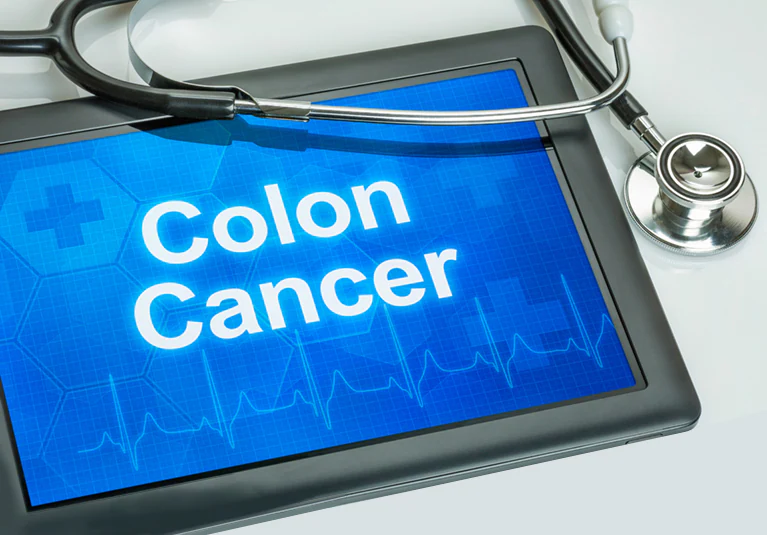 colon cancer a