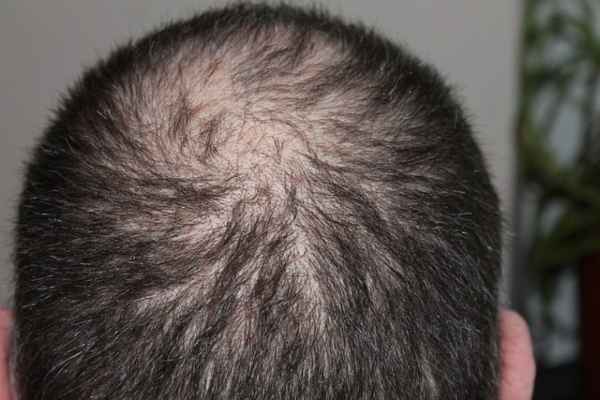 alopekiasi 1