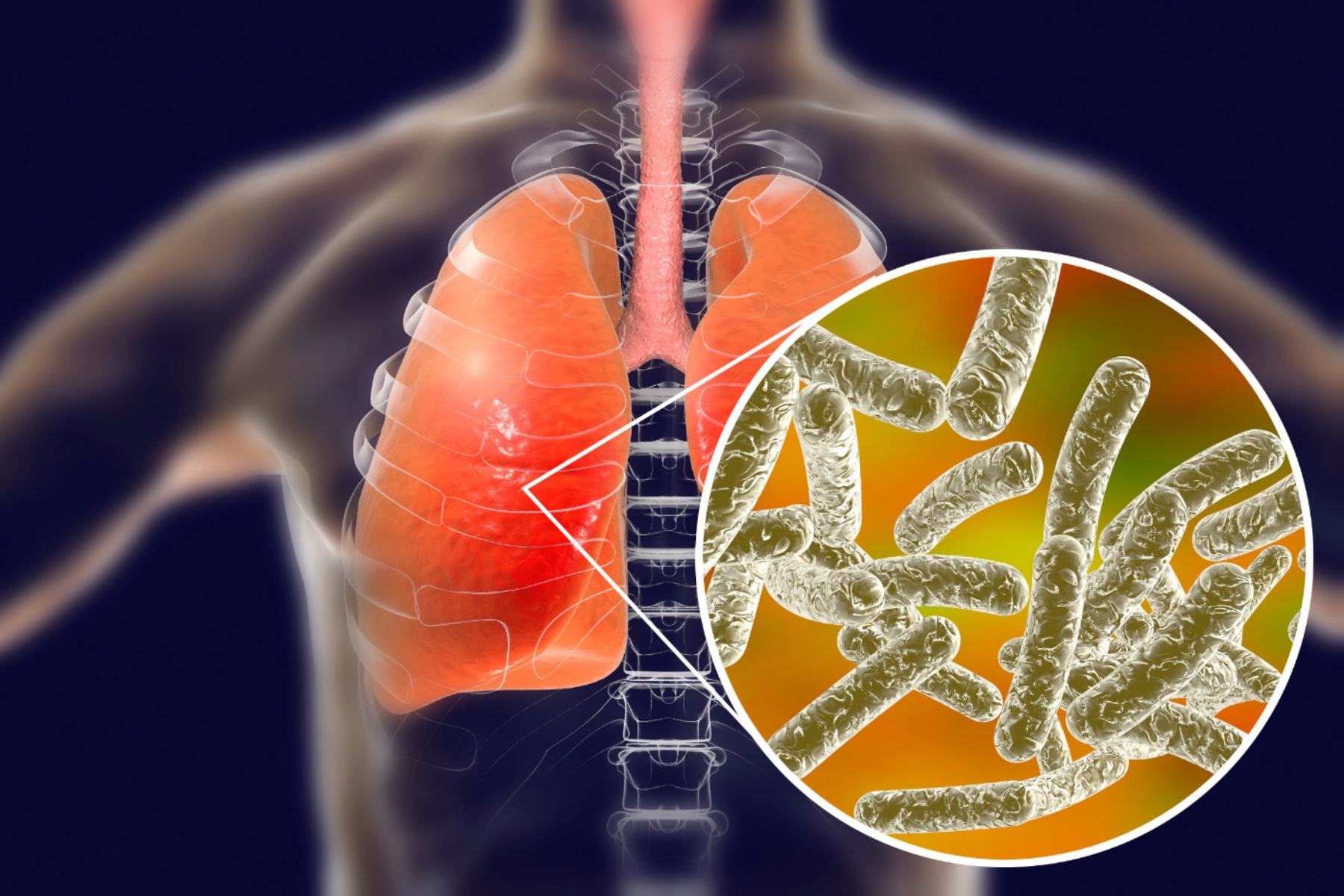 legionnaires disease featured image