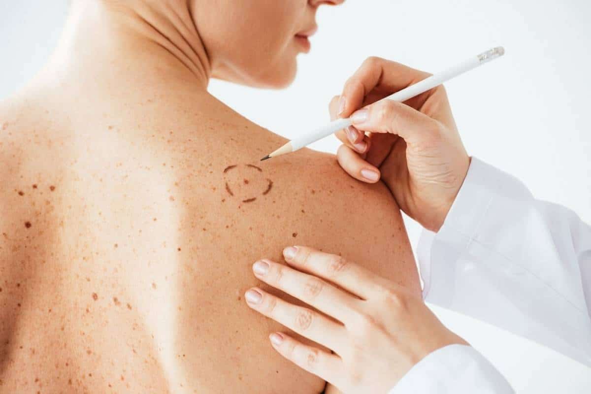 melanoma derma