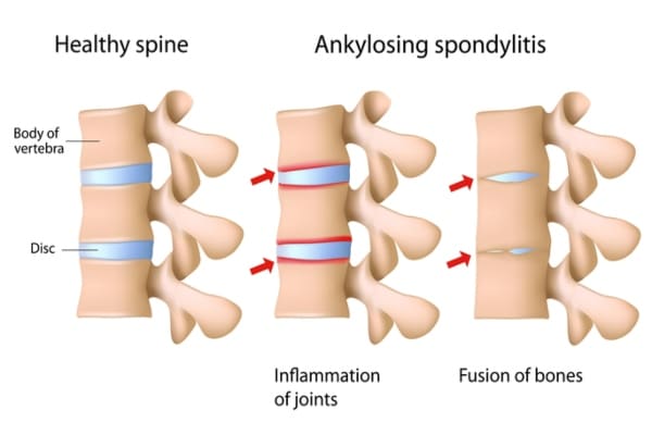 spondylitida