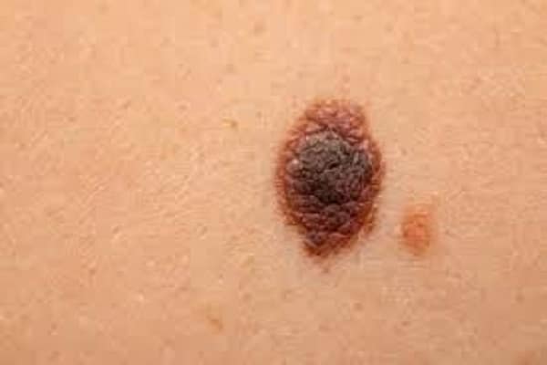 melanoma