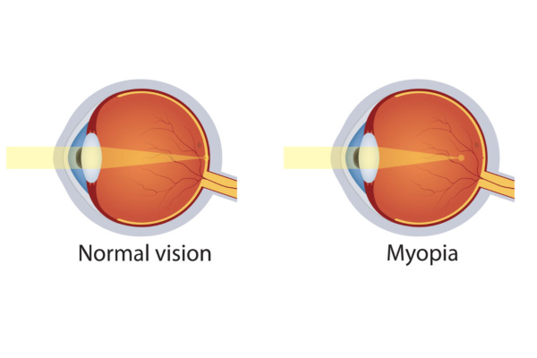 myopia2