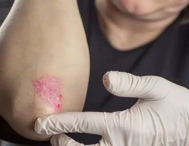 psoriasis