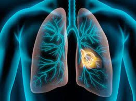 lung cancer a