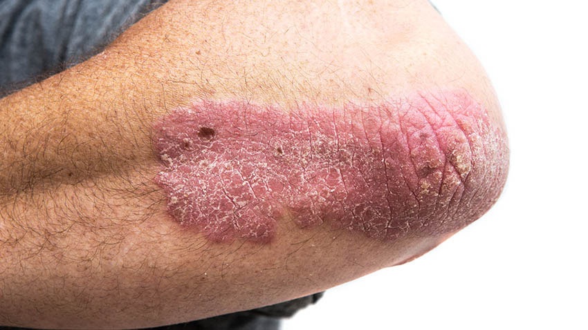 psoriasis on elbow