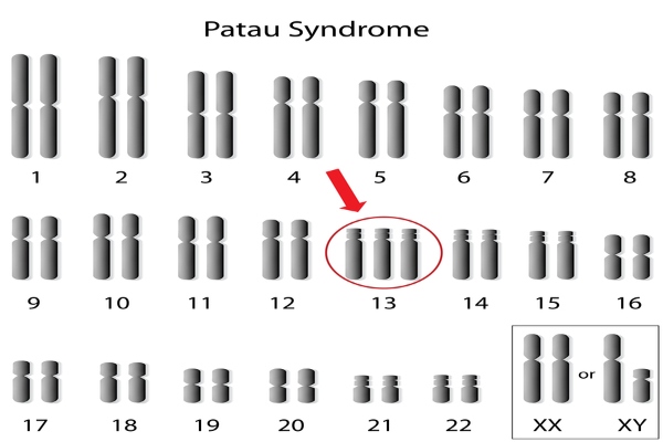 patau1ready