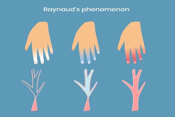 raynaud2ready