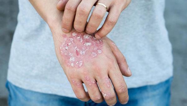 psoriasis c