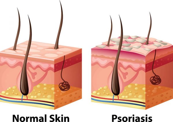 psoriasis illustration 8753ef e1640448765110