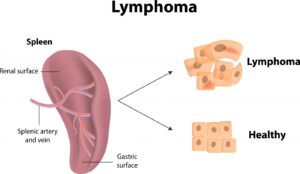 lemfoma